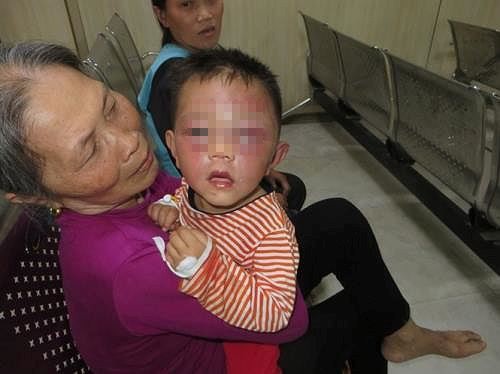 Triệu tập cha dượng vì nghi bạo hành con riêng của vợ Cháu Hiếu nhập viện trong tình trạng đa chấn thương.