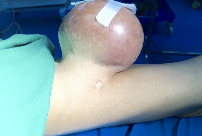 ‘Giải cứu’ người đàn ông mang khối u nặng 2kg suốt hàng chục năm ‘Giải cứu’ người đàn ông mang khối u nặng 2kg suốt hàng chục năm