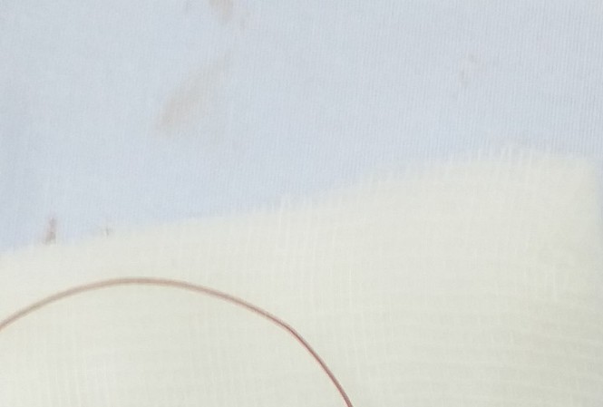 Tổn thương thị lực tới 99% vì bị lưỡi câu móc trúng mắt khi đi câu cá Tổn thương thị lực tới 99% vì bị lưỡi câu móc trúng mắt khi đi câu cá