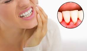 Trị viêm lợi bằng nguyên liệu dễ kiếm Trị viêm lợi bằng nguyên liệu dễ kiếm