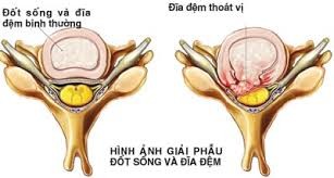 Thoát vị đĩa đệm: Nguyên nhân từ những thói quen sai Thoát vị đĩa đệm: Nguyên nhân từ những thói quen sai