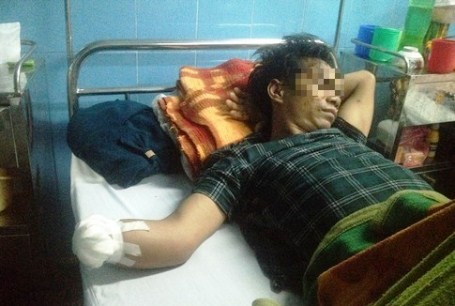 Đốt pháo chơi Tết, 3 người nhập viện cấp cứu 1 trong 3 nạn nhân ở Quảng Bình phải nhập viện cấp cứu.