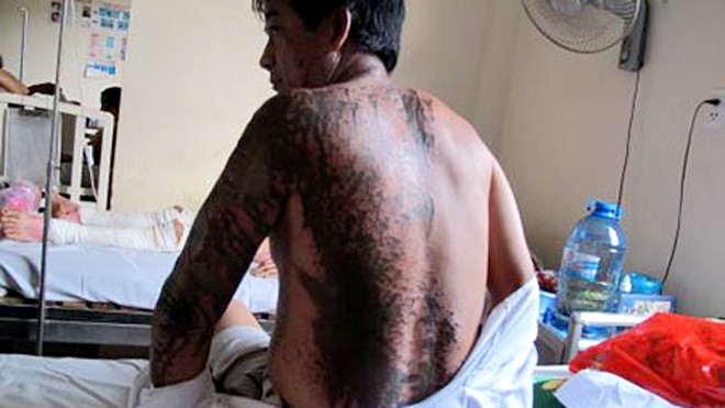 Tạt axít kinh hoàng, 4 người trọng thương Ông Hà hứng trọn ca axit của hai kẻ lạ mặt