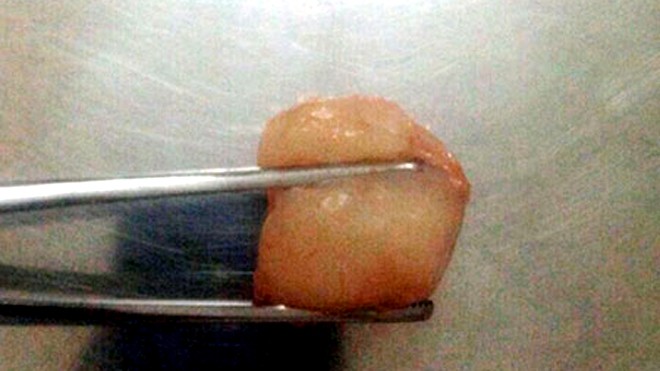 Hà Nội: Hóc vải, bé trai 6 tuổi tử vong thương tâm Quả vải gây ra cái chết thương tâm cho bé trai 6 tuổi