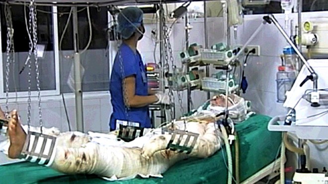 Tháo khớp gối hoại tử, cứu chiến sĩ rơi máy bay Một chiến sĩ bị thương trong vụ máy bay Mi 171 rơi đang điều trị tại Viện bỏng quốc gia. Ảnh: D. Thu (Báo Người Lao Động)