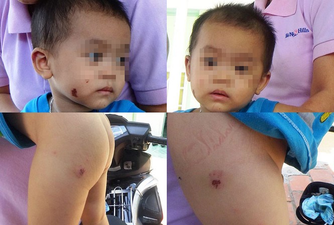 Bé trai 19 tháng tuổi nghi bị đánh bầm dập Bé trai 19 tháng tuổi nghi bị đánh bầm dập