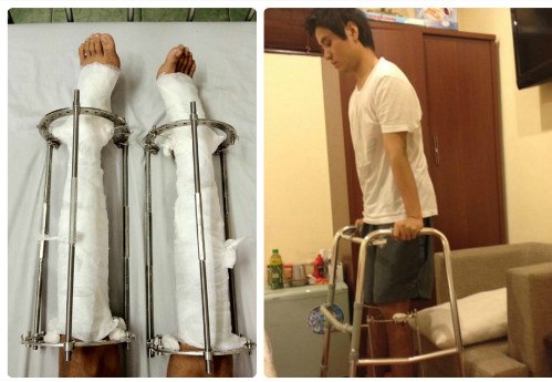 Chàng trai phẫu thuật kéo chân tăng 9 cm chiều cao Chàng trai trải qua những ngày tháng đóng đinh cố định xương và tập đi tại nhà