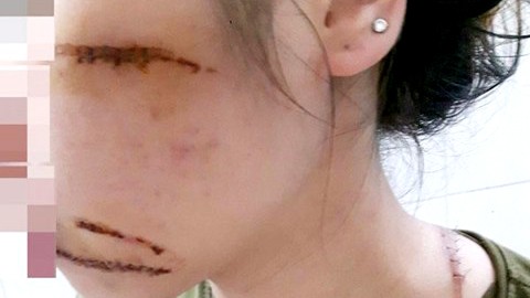 Nữ nhân viên spa bị 4 côn đồ vây chém nhầm Chị Hạnh bị nhóm côn đồ chém trọng thương