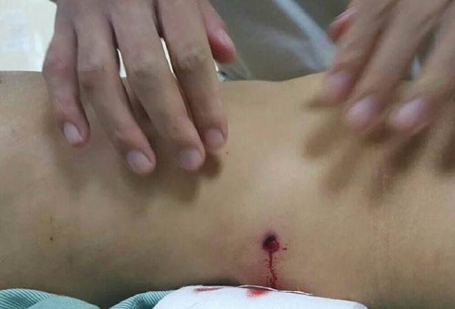 Người phụ nữ bị đạn bắn thủng bụng khi đang đi trên đường Viên đạn xuyên thủng vùng bụng của nạn nhân