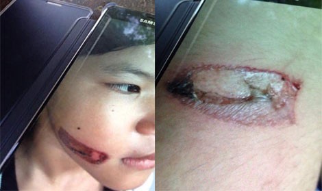 Bé gái 7 tuổi tố bị cha, mẹ kế dí sắt nung đỏ vào mặt Hình ảnh do giáo viên nhà trường Vĩnh Thạnh chụp lại từ em T.