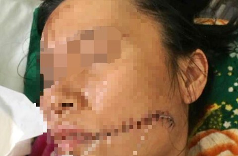 Rạch mặt người tình rồi tưới xăng thiêu sống để 'chết chung' Ngoài vết bỏng 60% chị Mai còn bị vết thương khâu 20 mũi