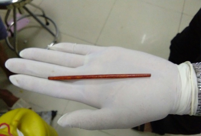 Tỉnh sau nhậu say, 'tá hỏa' phát hiện đũa dài 12cm trong... niệu đạo Tỉnh sau nhậu say, 'tá hỏa' phát hiện đũa dài 12cm trong... niệu đạo