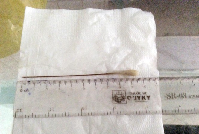 Gắp thành công tăm tre dài gần 10 cm ra khỏi phổi cụ ông Gắp thành công tăm tre dài gần 10 cm ra khỏi phổi cụ ông