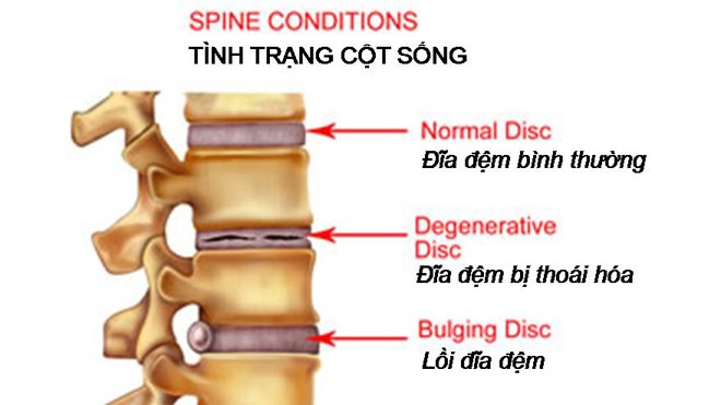 Thoái hóa cột sống - Làm thế nào để khỏi bệnh? Thoái hóa đĩa đệm với sự hình thành gai xương
