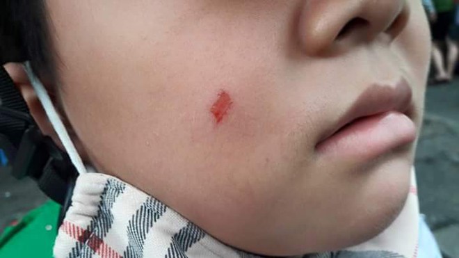 Phụ huynh đánh nhầm cô giáo bị phạt 7 triệu đồng Má em H.G, học sinh trường TH và THCS Đức Trí bị trầy xước.