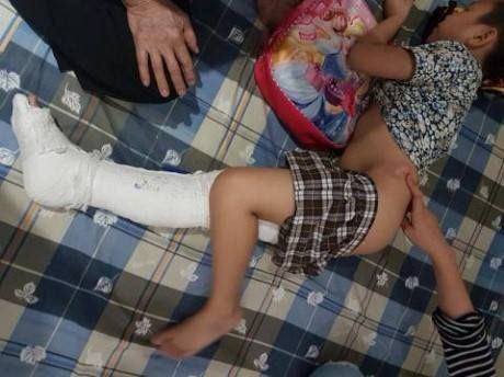 Phụ huynh cháu bé gãy chân: Không muốn ai bị cách chức Vết thương của cháu Kiên