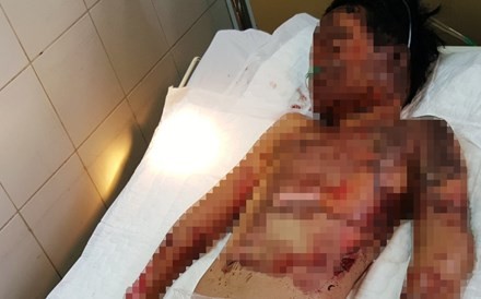 Dùng xăng nướng khoai, học sinh lớp 5 nguy kịch Dùng xăng nướng khoai, học sinh lớp 5 này hiện nguy kịch tính mạng do bỏng nặng.
