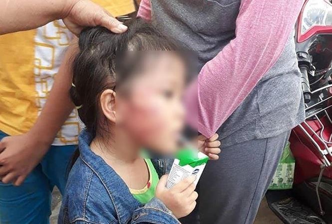 Bản tin 8H: Vụ đánh trẻ nứt xương hàm, bảo mẫu khai chỉ đánh để dọa Bé Chi (5 tuổi) với thương tích trên mặt nghi bị cô giáo bạo hành. Ảnh: Người nhà cung cấp