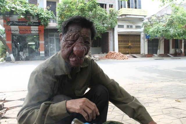 Người đàn ông mang gương mặt “quỷ“ Ông Đỗ Văn Luyện và khối u quái ác trên mặt.