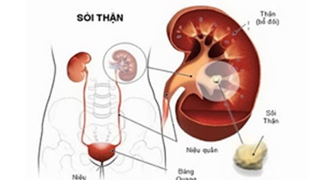 Những biến chứng của bệnh sỏi thận Những biến chứng của bệnh sỏi thận