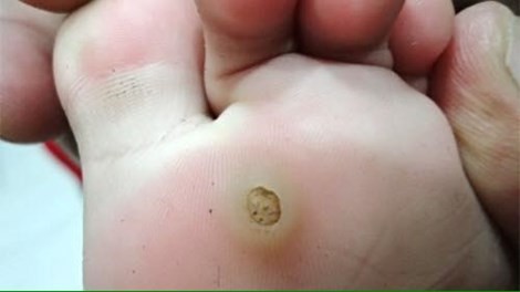 Đừng coi thường mụn cóc lòng bàn chân Mụn cóc là do một loại virus xâm nhập vào cơ thể qua vết nứt trên da. Ảnh: BS Xuân Anh.