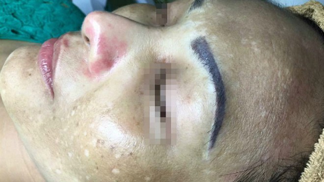 Cẩn trọng với kem ốc sên làm trắng da siêu tốc Một bệnh nhân bị nám kín đặc do sử dụng kem ốc sên và một số mỹ phẩm chưa kiểm định khác. Ảnh: congdongmypham.