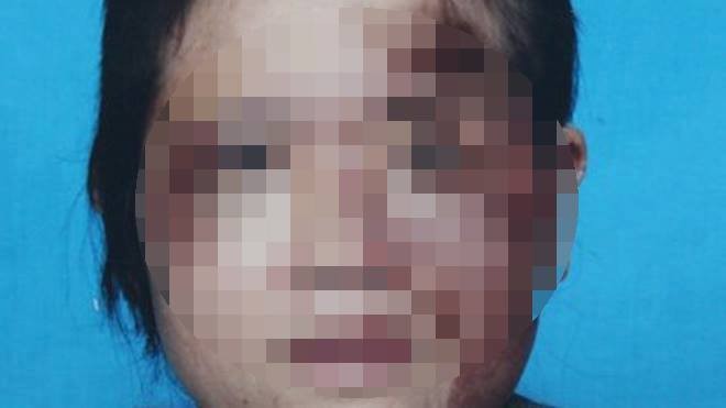 Nghi án bị chồng bạo hành dã man vì tham gia đa cấp Chị H. với khuôn mặt biến dạng