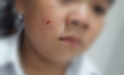 Cô giáo làm xước má học sinh bị đình chỉ một tháng Em H.G.