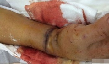 Chém đứt lìa tay vợ trước sân tòa Bàn tay chị Thắm đã được Bệnh viện Đa khoa tỉnh Kiên Giang nối lại thành công.