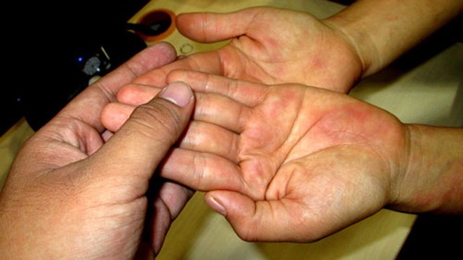 Không nên đắp lá, tự chữa khi bị phát ban, nổi mẩn Một trường hợp tổn thương da khiến người bệnh lầm tưởng là những dấu xuất huyết dưới da nhưng thật ra là bị đỏ da do dị ứng