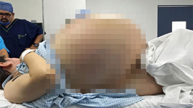 Người phụ nữ mang khối u nang nặng 33 kg Khối u từng khiến cô gái gặp khó khăn trong vận động, đi lại. Ảnh: Caters