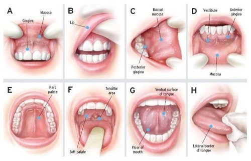 Dễ nhầm lẫn giữa nhiệt miệng, loét miệng với ung thư khoang miệng 8 bước khám khoang miệng để phát hiện sớm ung thư.
