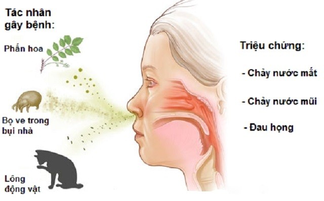 Làm sao để giảm viêm mũi dị ứng khi thời tiết nồm ẩm? Triệu chứng và các tác nhân gây viêm mũi dị ứng.