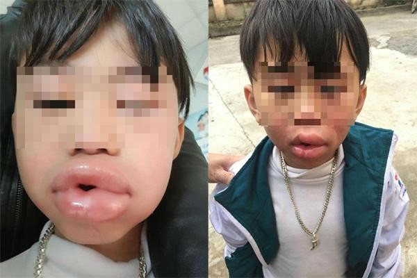 Học sinh tiểu học nhập viện sau 3 phút ăn kẹo mua ở cổng trường Hình ảnh cháu bé bị sưng môi sau khi ăn kẹo. Ảnh: GĐCC.