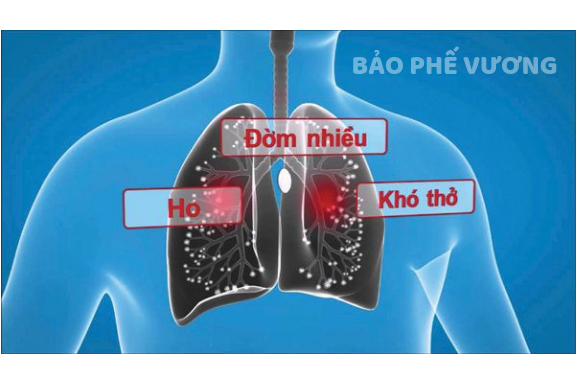Ho, đờm kéo dài do viêm phế quản phải làm sao? Ho khan, ho đờm là các triệu chứng thường gặp của viêm phế quản