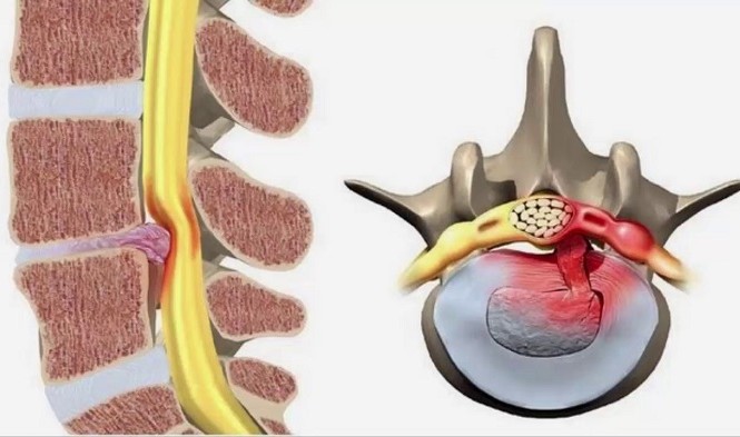 Điều trị thoát vị đĩa đệm: Top 6 địa chỉ uy tín tại Hà Nội Điều trị thoát vị đĩa đệm: Top 6 địa chỉ uy tín tại Hà Nội