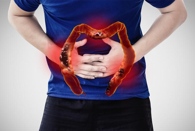 Tìm lại sự sống nhờ thoát “nỗi khổ” viêm đại tràng Viêm đại tràng nỗi ám ảnh kinh hoàng