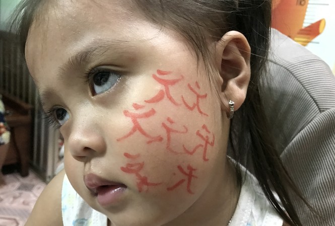 Nhập viện vì để thầy cúng vẽ bùa lên mặt điều trị nhiễm trùng hàm mặt Nhập viện vì để thầy cúng vẽ bùa lên mặt điều trị nhiễm trùng hàm mặt