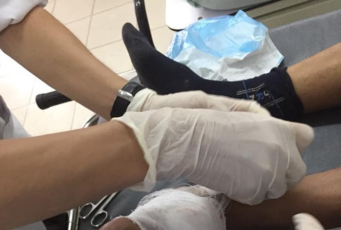 Xà beng 'từ trên trời' xuyên thủng bàn chân nam công nhân Nam công nhân đến bệnh viện cấp cứu trong tình trạng cây xà beng đâm xuyên thủng bàn chân.