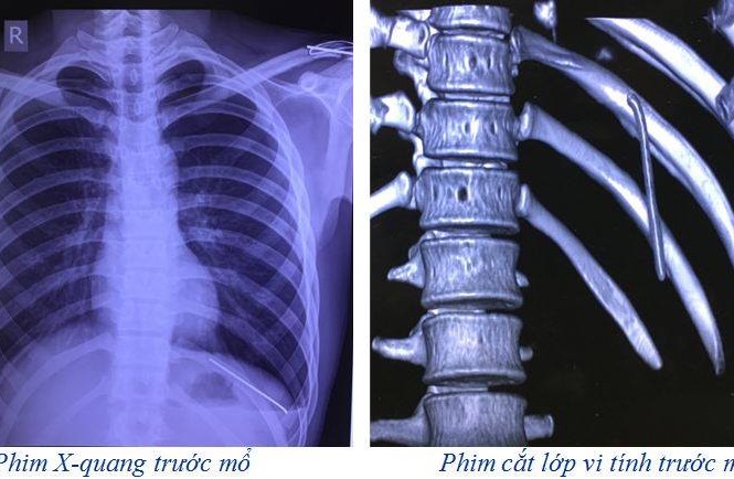 Thanh niên 18 tuổi bị đinh dài 7 cm 'du lịch' từ vai xuống tận phổi Ảnh: BV cung cấp