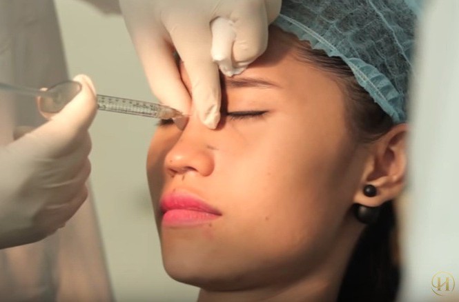 Tiêm filler tại spa, một thiếu nữ bị tổn thương thị lực Tiêm filler tại spa, một thiếu nữ bị tổn thương thị lực