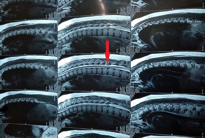 Xẻ màng tủy cứu đôi chân bệnh nhân u tủy sống ngực Hình ảnh chụp MRI khối u trước phẫu thuật.