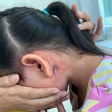Ghi nhận bệnh nhân nhiễm vi khuẩn 'nguy hiểm' thứ 2 tại Bình Định Ghi nhận bệnh nhân nhiễm vi khuẩn Whitmore thứ 2 tại Bình Định.