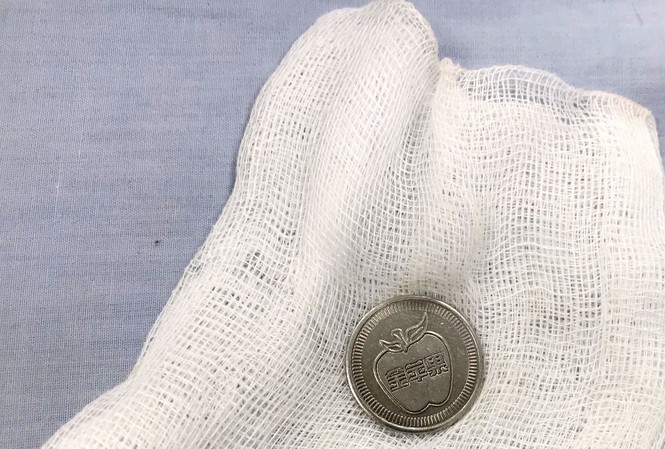 Cứu bé 3 tuổi bị đồng xu mắc chẹn ngang thực quản Đồng xu được gắp ra ngoài.