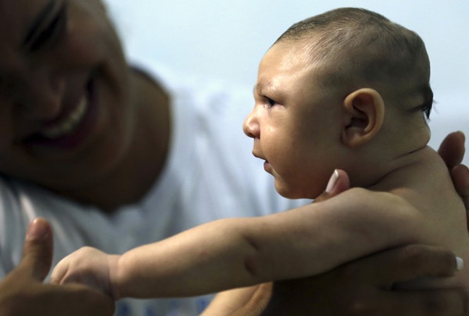 Em bé đầu nhỏ vì Zika ra đời lần đầu tiên ở châu Âu Bé Juan Pedro mắc chứng đầu nhỏ vì Zika ở Recife, Brazil
