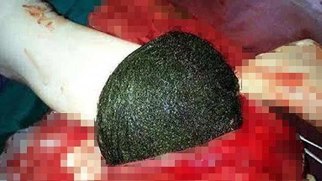 Một phụ nữ Mỹ có búi tóc to bằng quả dưa hấu trong bụng Búi tóc được đưa ra khỏi bụng bệnh nhân.
