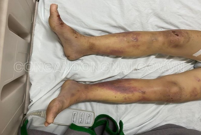 Khởi tố chủ quán cà phê kích dục tra tấn nhân viên đến nhập viện Khởi tố chủ quán cà phê kích dục tra tấn nhân viên đến nhập viện