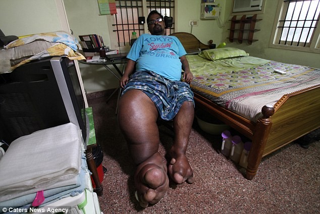 Người đàn ông có chân nặng… 100kg Anh Arun Rajasingh. Ảnh: Dailymail