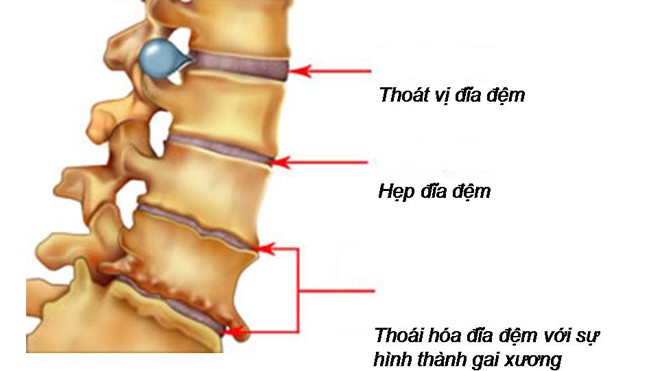 Liều thuốc kỳ diệu cho bệnh xương khớp Biểu hiện của bện thoát vị đĩa đệm