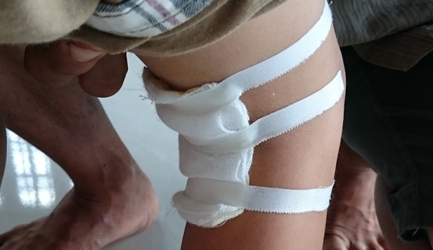 Bệnh nhân đau chân trái, bác sĩ mổ... chân phải BS tự ý mổ chân phải bé Hào không thông báo gia đình.